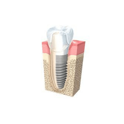 Impianti Dentali Pinerolo