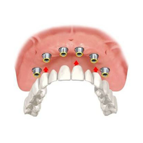 Impianti Dentali Pinerolo