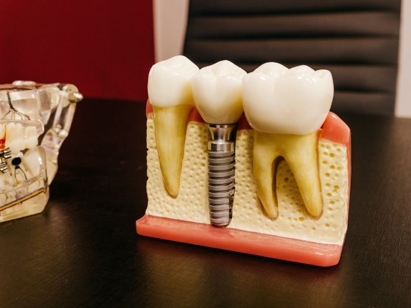 Impianto dentale: quanto può durare